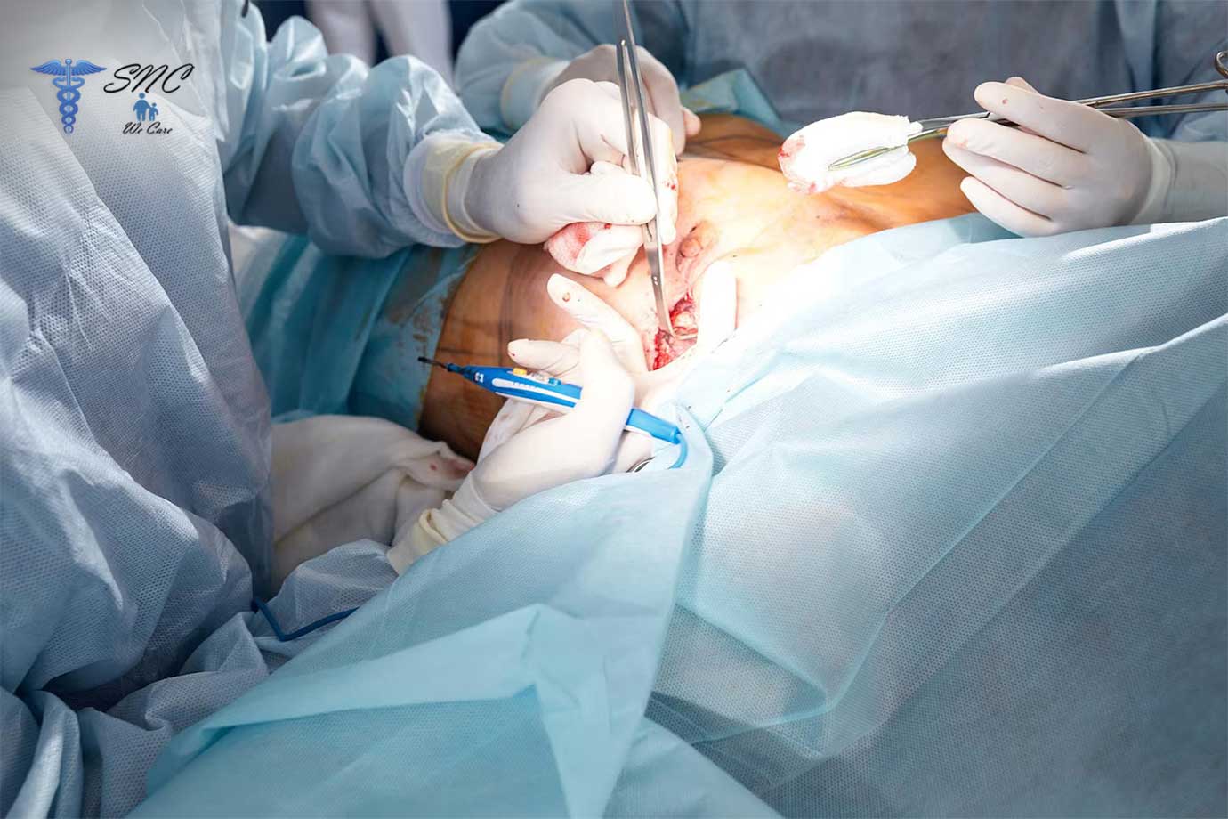 ectopic surgery